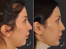 Chin Reshaping and Augmentation with Fillers