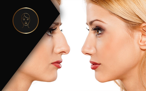 Jaw Reshaping and Augmentation with Fillers